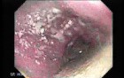 Esophageal Achalasia - 32 Years Old Patient