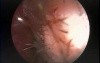 Frontal Sinus Mucocoele - Endoscopic Treatment