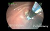 Endoscopic Treatment of Impacted Stone in the Vater Papilla