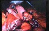 Jejunal Gastrointestinal Stromal tumor (GIST) (49 of 86)