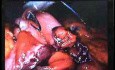 Jejunal Gastrointestinal Stromal tumor (GIST) (49 of 86)