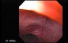 Esophageal Mucosal Bridge - 80 Years-Old Female