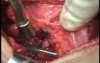 Perforation of a Esophageal Carcinoma After the Procedure with Hydrostatic Balloon Dilation - Beginning of the Surgery