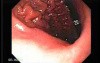 Adenocarcinoma of the Lesser Curvature with Signet Ring Cells (4 of 8)