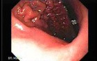 Adenocarcinoma of the Lesser Curvature with Signet Ring Cells (4 of 8)