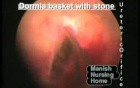 Ureteral Stone- Removal Of The Stone