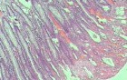 Case on Multiple Adenomas (large polyps) of the Rectum (36 of 37)
