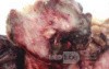 Metastasis of Renal Carcinoma to the ascending colon (11 of 11)