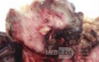 Metastasis of Renal Carcinoma to the ascending colon (11 of 11)