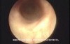 Dumon Stent In The Left Main Bronchus