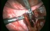 Isolation and ligation of uterine arteries at its origin