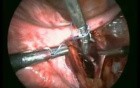 Isolation and ligation of uterine arteries at its origin