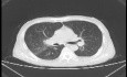 Lung Adenocarcinoma (2 of 5)