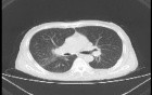 Lung Adenocarcinoma (2 of 5)