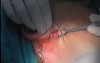 Scarless Neck SMAS Lift and Lower Face