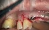 Narrow Diameter Anterior Bridge