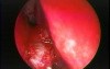 Nasal Septal Spur - Endoscopic Removal