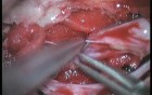 Sacral Meningeal Cysts - Posterior Approach