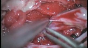 Sacral Meningeal Cysts - Posterior Approach