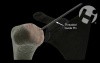 Humeral Head Resurfacing