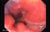 Barrett Esophagus -GERD- (1 of 6)