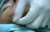 Chin augmentation without Scars