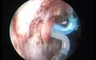 Transurethral Plasma Vaporization Of The Prostate In Saline Water