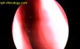 Epistaxis Due To Anterior Ethmoidal Artery
