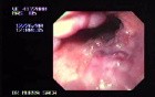 Alcoholic Cirrhosis as a Cause of Esophageal Varices