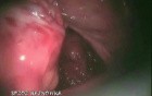Laparoscopic Anterior Resection Of Rectum