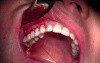 Native Tissue Suturing - Gingival Grafting #3-6 Sites