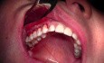 Native Tissue Suturing - Gingival Grafting #3-6 Sites