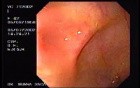 Crohn's Disease - Endoscopy (17 of 28)