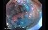 Colonic Tuberculosis Mimicking Crohn's Disease (11 of 12)