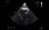Echocardiography - Transgastric View