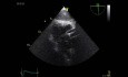 Echocardiography - Transgastric View