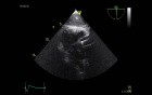 Echocardiography - Transgastric View