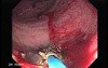 Tubulo - Villous Rectal Adenoma - Endoscopy (33 of 35)
