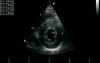 Hypertrophic Cardiomyopathy