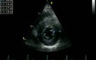 Hypertrophic Cardiomyopathy