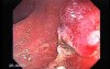 Endoscopic Appearance of Pedicled Polyp of the Descending Colon (7 of 7)