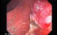 Endoscopic Appearance of Pedicled Polyp of the Descending Colon (7 of 7)