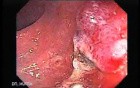 Endoscopic Appearance of Pedicled Polyp of the Descending Colon (7 of 7)