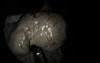 Nasal Polyp Surgery
