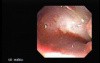 Tracheal Endoscopy - state after surgery of the larynx
