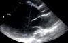 Dilated Cardiomyopathy (DCM)