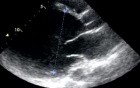Dilated Cardiomyopathy (DCM)