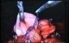 Jejunal Gastrointestinal Stromal tumor (GIST) (52 of 86)