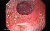 Ileal Neobladder Substitution (ileal bladder) (2 of 9)