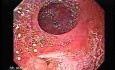 Ileal Neobladder Substitution (ileal bladder) (2 of 9)